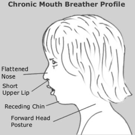 Pediatric Sleep Disordered Breathing and Speech Sound Errors – Speech ...