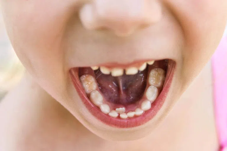 Does Being Tongue-Tied Effect Your Child’s Speech?